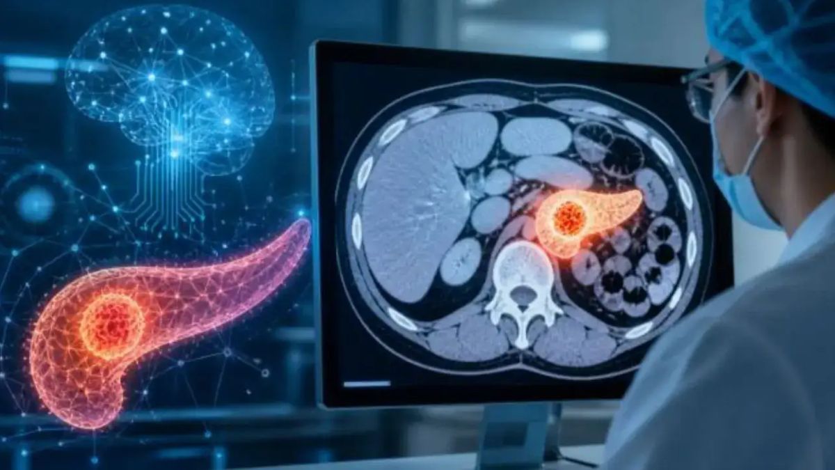 The End Of The “Silent Killer?” AI Now Detects Pancreatic Cancer Early