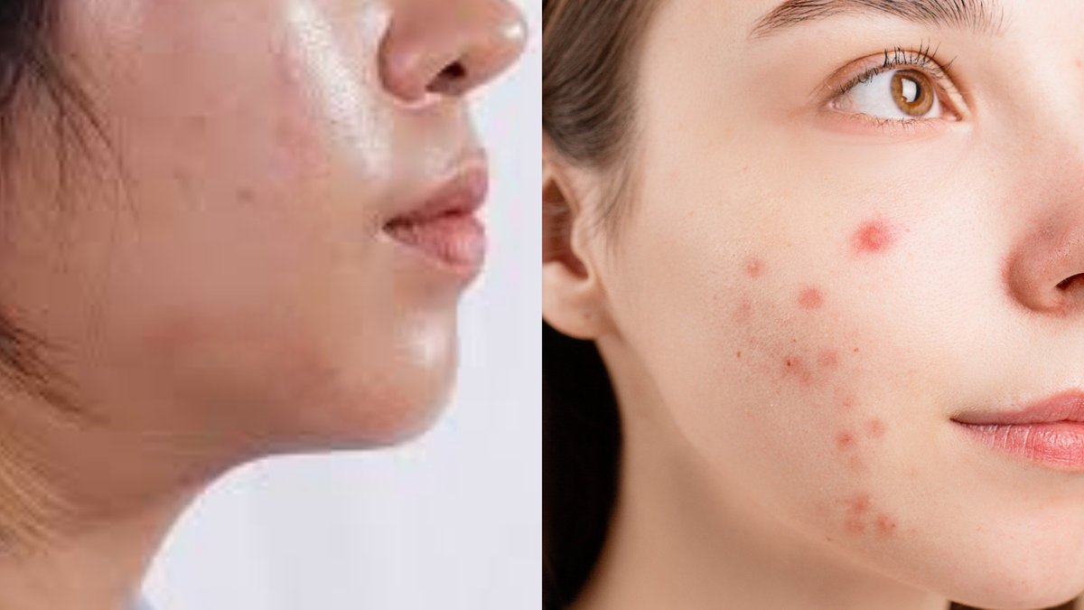 Eating This Daily? It Might Be Triggering Your Acne
