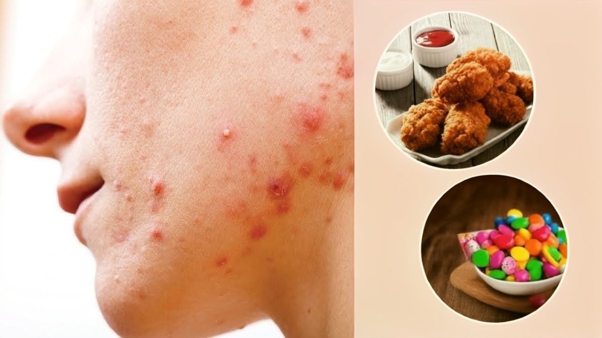 Eating This Daily? It Might Be Triggering Your Acne