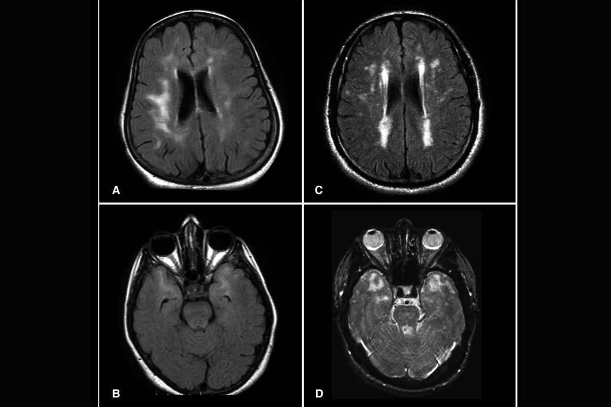MRI scans
